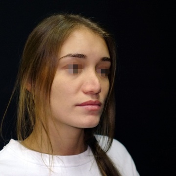 Результат после повторной ринопластики ранее проведённой в другой клинике. Закрытая ринопластика через 10 месяцев после операции.